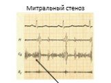 Ревматизм Слайд: 30