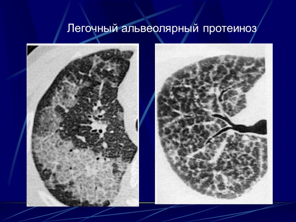 Диффузные легкого. Альвеолярный протеиноз легких на кт. Альвеолярный протеиноз легких рентген. Легочный альвеолярный протеиноз кт. Интерстициальные заболевания лёгких кт.