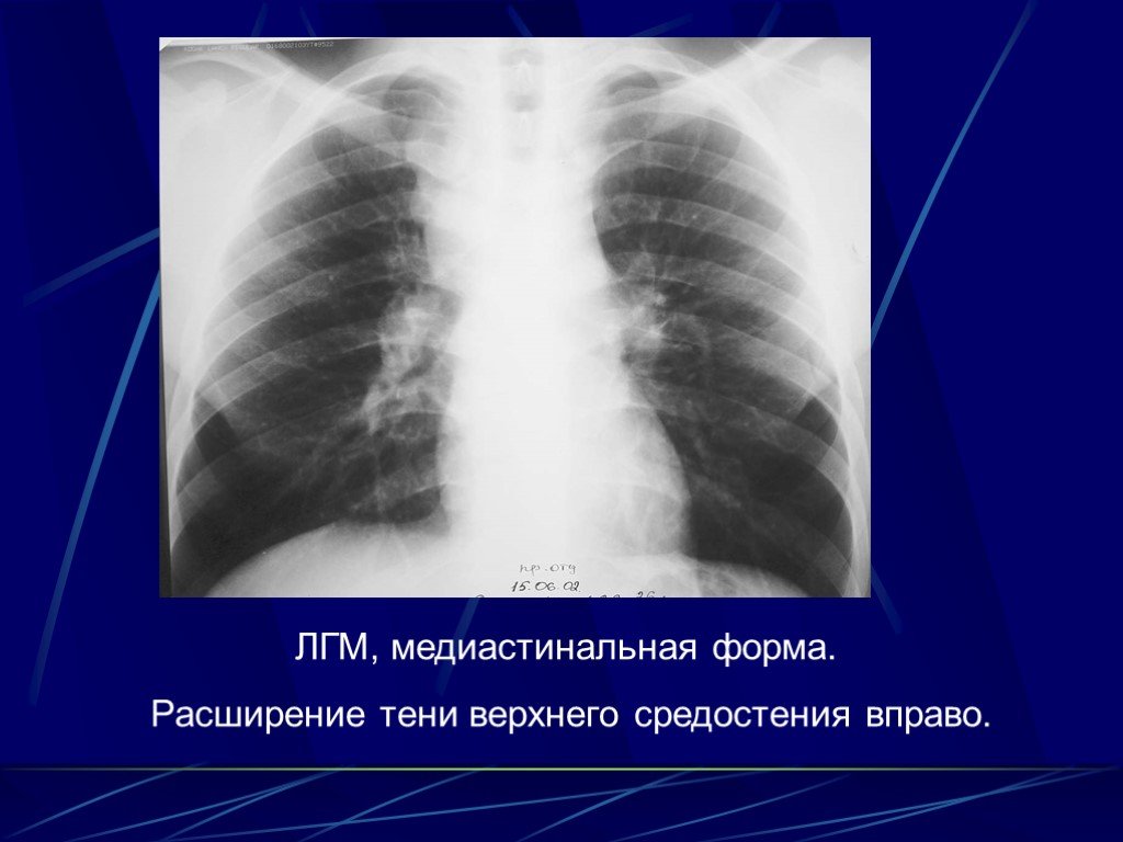 Презентация интерстициальные заболевания легких