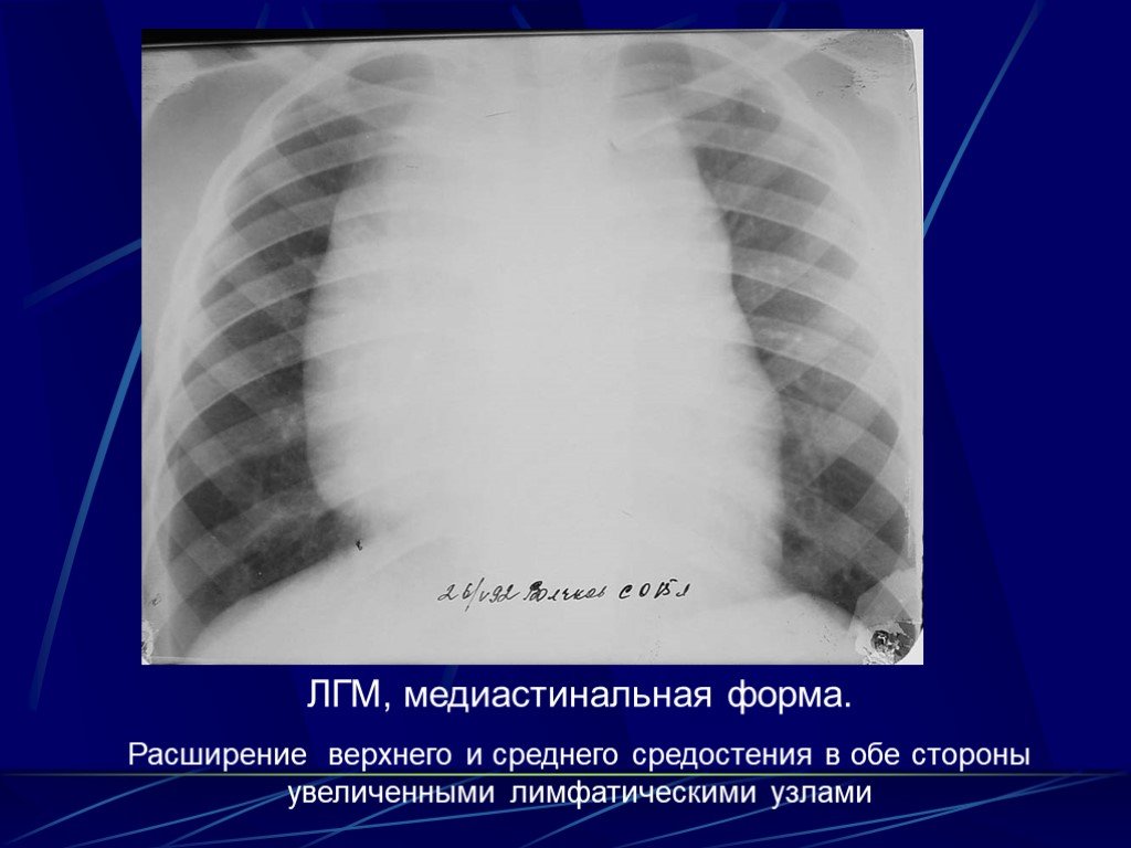 Презентация интерстициальные заболевания легких