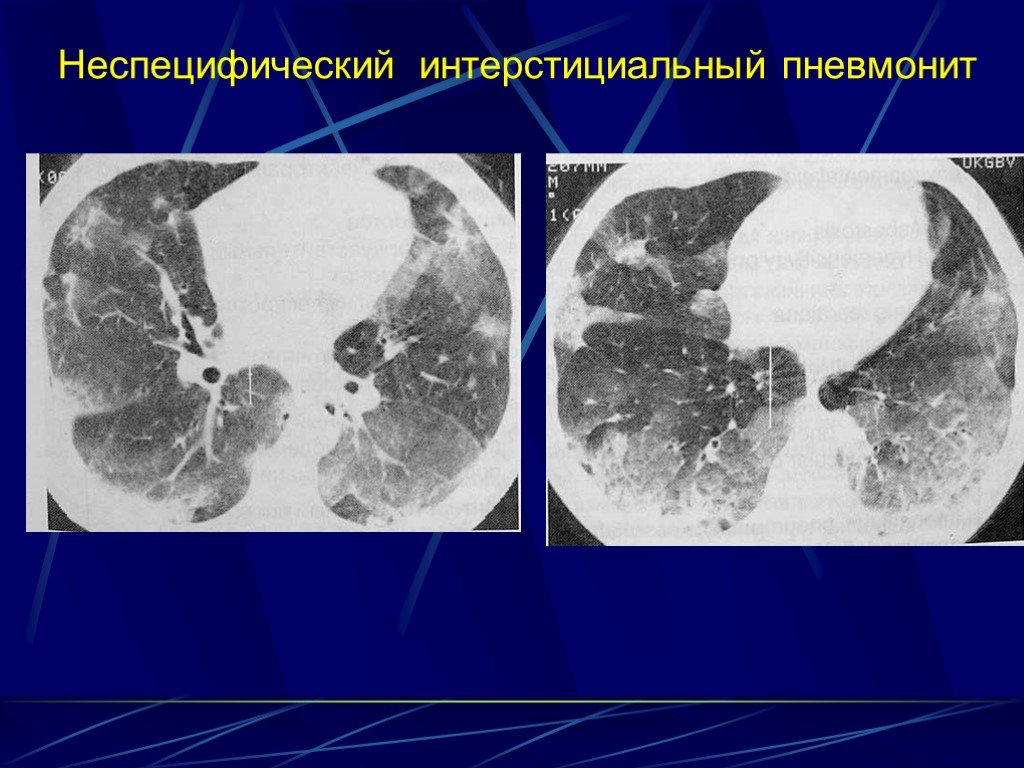 Пневмонит это. Неспецифическая интерстициальная пневмония кт. Ревматоидный артрит кт легких. Десквамативная интерстициальная пневмония кт. Острая интерстициальная пневмония кт.