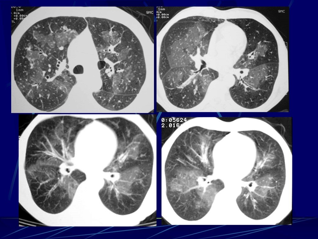 Картина интерстициальных изменений в легких кт что это