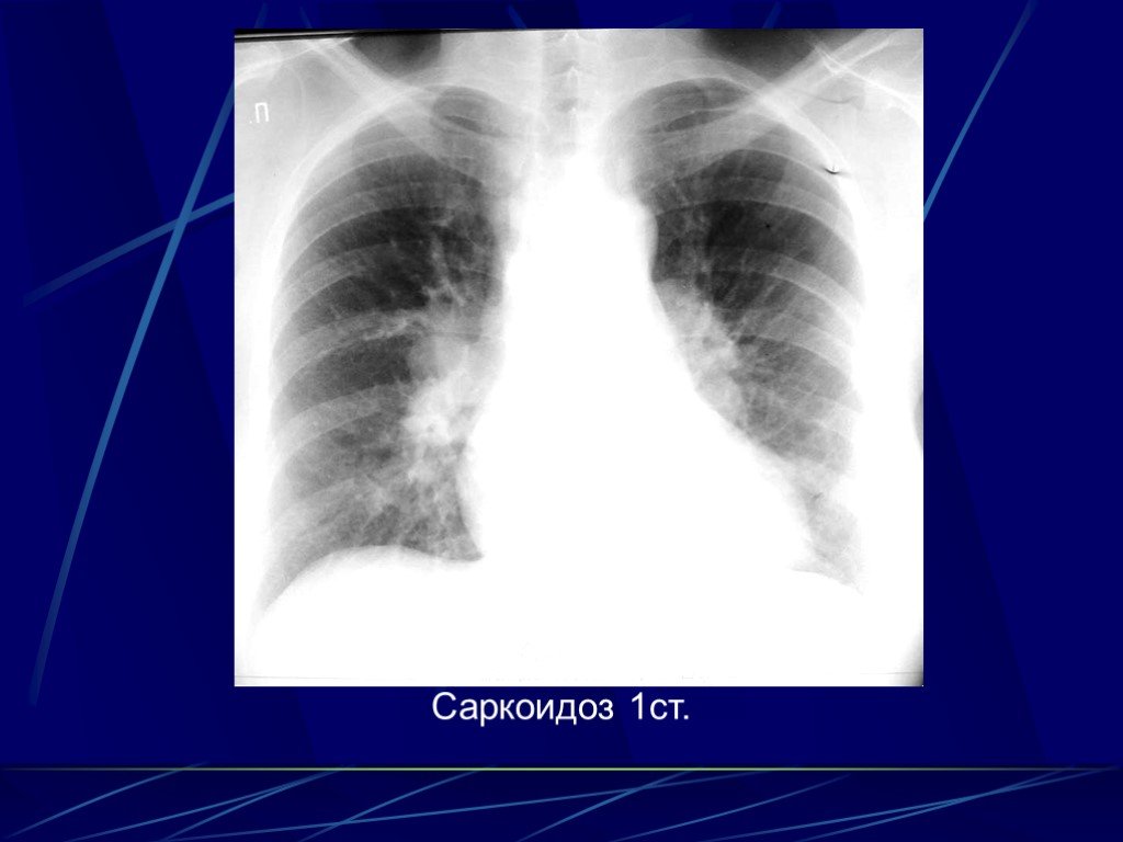Легкие диффузные. Легочно медиастинальная форма саркоидоза. Саркоидоз внутригрудных лимфоузлов рентген. Саркоидоз легочная форма.