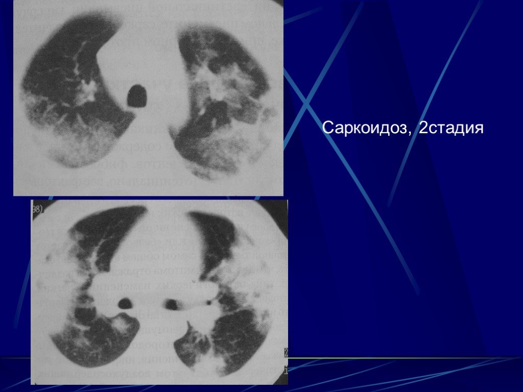 Саркоидоз это. Саркоидоз 2 стадии кт легких. Саркоидоз 2 стадии рентген. Саркоидоз легких 3 степени.