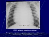 Интерстициальные болезни лёгких Слайд: 123