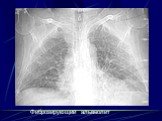 Интерстициальные болезни лёгких Слайд: 43