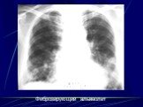 Интерстициальные болезни лёгких Слайд: 44