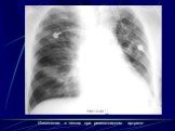 Интерстициальные болезни лёгких Слайд: 51