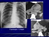 Интерстициальные болезни лёгких Слайд: 64