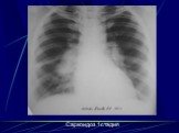 Интерстициальные болезни лёгких Слайд: 65