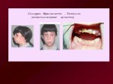 Синдром Франческетти – Коллинза (челюстно-лицевой дизостоз);