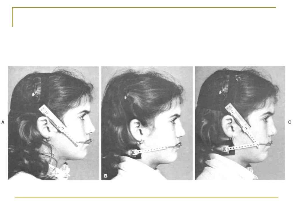 Мезиальный темпоральный склероз. Дистальный и мезиальный прикус. Внеротовые ортодонтические аппараты лицевая дуга. Лицевая дуга дистальный прикус.