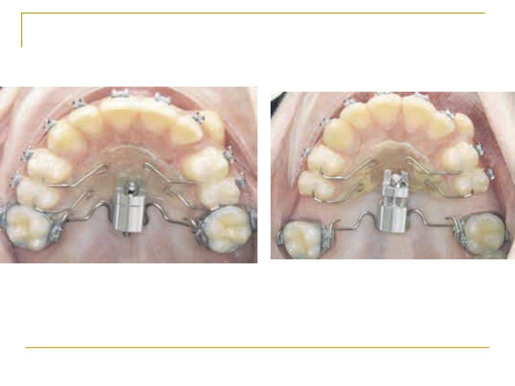 Расширения операция. Микроимпланты для расширения челюсти. Дистрактор для расширения челюсти. Ортодонтические микроимпланты на верхней челюсти. Аппарат для расширения челюсти взрослым.