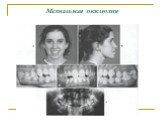 Аномалии зубных рядов и челюстей у взрослых Слайд: 53