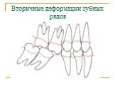 Вторичные деформации зубных рядов