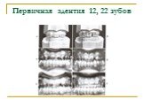 Первичная адентия 12, 22 зубов