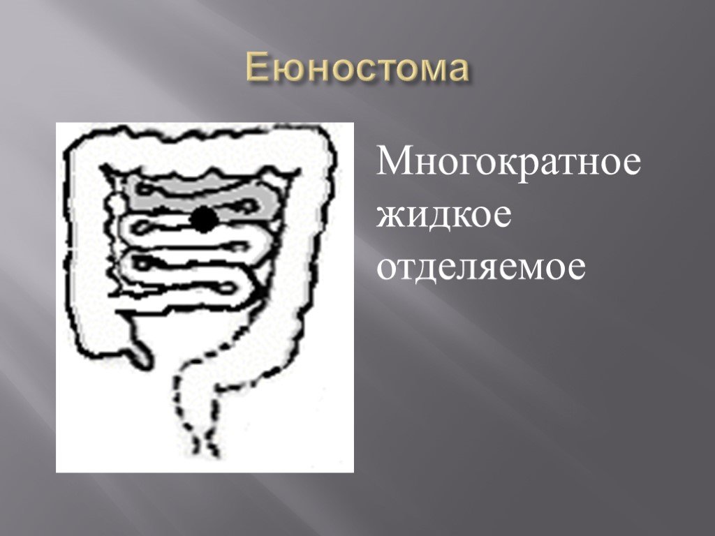 Еюностома. Еюностома накладывается на. Еюностома презентация.