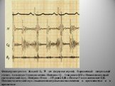 Фонокардиограмма больной Б., 35 лет (верхушка сердца). Выра­женный митральный стеноз. Амплитуда I тона увеличена. Интервал Q — I тон равен 0,10 с. Низко­амплитудный систолический шум. Интервал II тон — OS равен 0,08 с. Индекс Уэллса составляет 0,02. Пандиастолический шум с высокоамплитудными осцилля