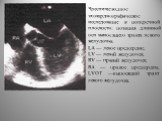 Чреспищеводное эхокардиографическое исследование в поперечной плоскости: позиция длинной оси выносящего тракта левого желудочка. LA — левое предсердие, LV — левый желудочек, RV — правый желудочек, RA — правое предсердие, LVOT —выносящий тракт левого желудочка.