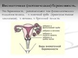 Внематочная (эктопическая) беременность. Это беременность, развивающаяся вне физиологического плодовместилища, - в маточной трубе (преимущественная локализация), в яичнике, в брюшной полости.