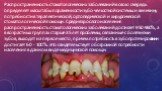 Распространенность стоматологических заболеваний в свою очередь определяет масштабы пораженности зубо-челюстной системы и величину потребности в терапевтической, ортопедической и хирургической стоматологической помощи. Среди взрослого населения распространенность стоматологических заболеваний достиг