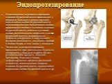 Эндопротезирование. Однополюсное эндопротезирование головки бедренной кости производят у пожилых больных с оскольчатыми переломами шейки бедренной кости, нерепонируемыми переломами шейки, переломами шейки с вывихом головки бедренной кости, ложных суставах шейки, асептическом некрозом головки бедренн