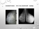 Маммограмма при раке молочной железы