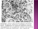 Микропрепарат мышцы в стадии частичной сохранности двигательной функции: беспорядочное расположение разнокалиберных мышечных волокон — атрофированных (1), нормального диаметра (2), единичных гипертрофированных (3); дистрофические изменения в части мышечных волокон (4); разрастание соединительной тка