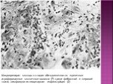 Микропрепарат мышцы в стадии обездвиженности: единичные атрофированные мышечные волокна (7) среди фиброзной и жировой ткани; лимфоидногистиоцитарная инфильтрация (2)
