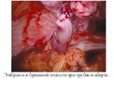 Эмбрион в брюшной полости при трубном аборте.