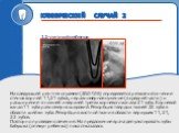 На следующей рентгенограмме (20.07.06) определяется резкое истончение стенок корней 11,21 зубов, неравномерное сужение (в средней части) и расширение в нижней и верхней третях корневого канала 21 зуба. Корневой канал 11 зуба равномерно широкий. Резорбция твердых тканей 22 зуба в области шейки зуба. 