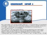 На представленной рентгенограмме (18.07.07 г.) отчетливо видна значительная резорбция твердых тканей 21, 22 зубов в области шейки и нижней 1/3 корня, а в 11 зубе – стенок корня в продольном направлении, снижение высоты перегородок между 11, 21, 22 зубами При такой рентгенологической картине, клиниче