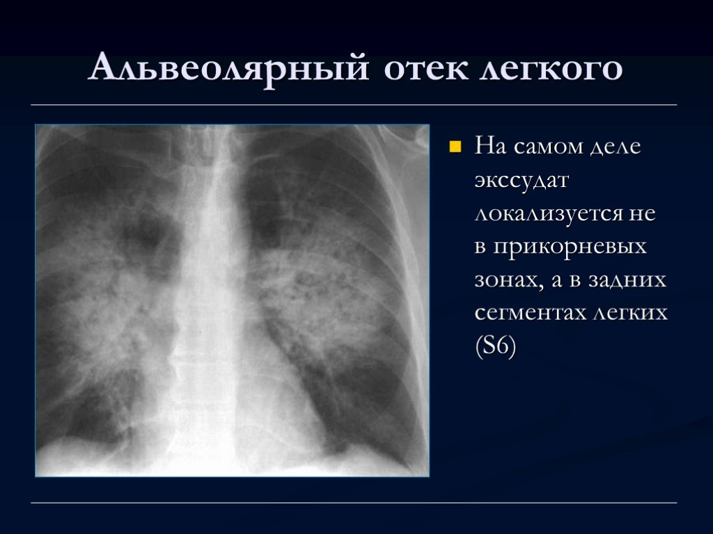 Отечность легких. Отёк лёгких рентген описание. Альвеолярный ОТК легкого рентген. Альвеолярный отек легкого рентген. Интерстициальный отек легких.