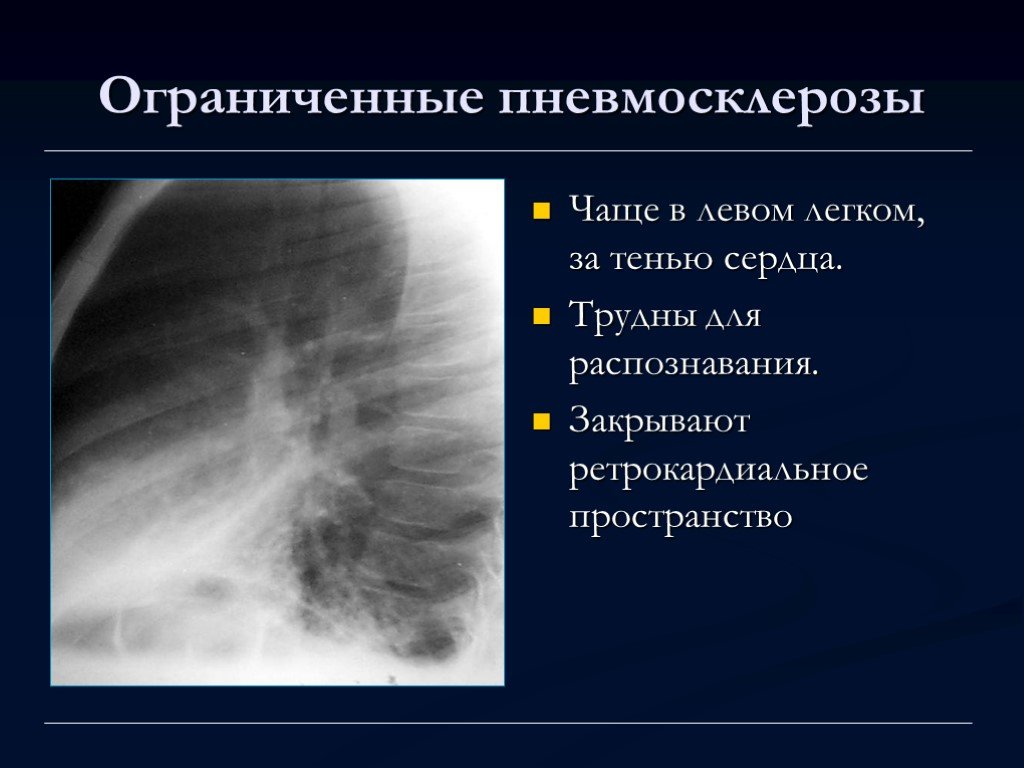 Пневмосклероз это простыми словами. Пневмосклероз рентген. Диффузный пневмосклероз рентген. Пневмосклероз рентгенограмма. Пневмосклероз легкого рентген.