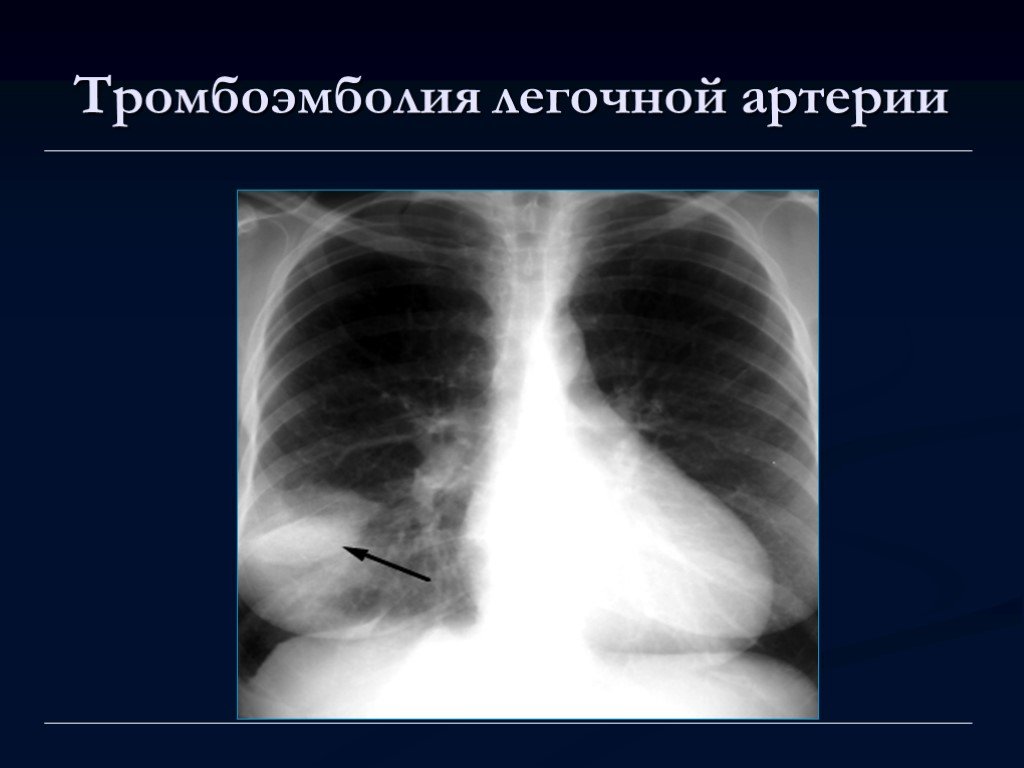 Тромболия легочной артерии. Инфаркт легкого при Тэла рентген. Рентгенодиагностика Тэла. Тромбоэмболия легочной артерии рентген. Тэла пневмония рентген.