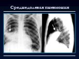 Лучевая диагностика заболеваний органов дыхания Слайд: 10