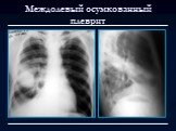 Лучевая диагностика заболеваний органов дыхания Слайд: 100