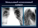 Лучевая диагностика заболеваний органов дыхания Слайд: 101