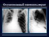 Лучевая диагностика заболеваний органов дыхания Слайд: 107