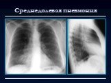 Лучевая диагностика заболеваний органов дыхания Слайд: 11