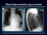 Лучевая диагностика заболеваний органов дыхания Слайд: 115