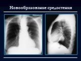 Лучевая диагностика заболеваний органов дыхания Слайд: 117