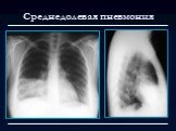 Лучевая диагностика заболеваний органов дыхания Слайд: 12