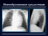 Лучевая диагностика заболеваний органов дыхания Слайд: 121