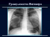 Лучевая диагностика заболеваний органов дыхания Слайд: 139