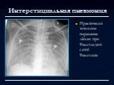 Практически тотальное поражение лёгких при Pneumocystis carinii Pneumonie