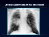 Лучевая диагностика заболеваний органов дыхания Слайд: 26