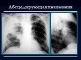 Лучевая диагностика заболеваний органов дыхания Слайд: 27