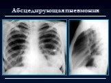 Лучевая диагностика заболеваний органов дыхания Слайд: 29