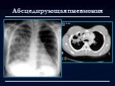 Лучевая диагностика заболеваний органов дыхания Слайд: 33